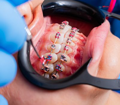 orthodontics-in-lucknow